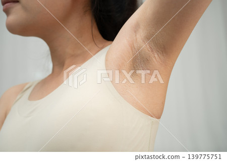 Asian woman have problem black armpit beauty skin care. Asian woman have problem black armpit beauty skin care. 139775751