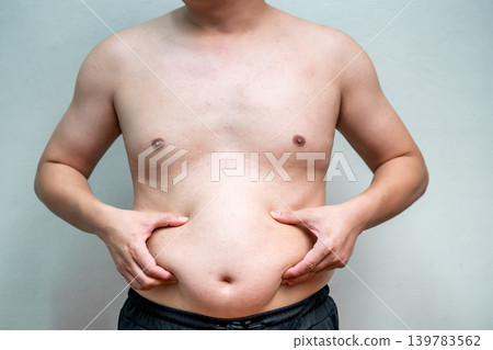 Overweight man pinches abdominal fat with both hands while standing against plain background. Shirtless body highlights excess weight and unhealthy lifestyle concerns. 139783562