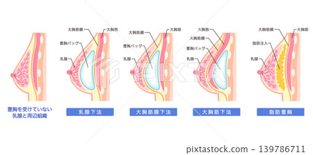 隆乳手術的類型和結構 隆乳手術的類型和結構 139786711