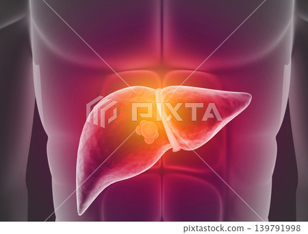 Diseased human liver with human body Diseased human liver with human body 139791998