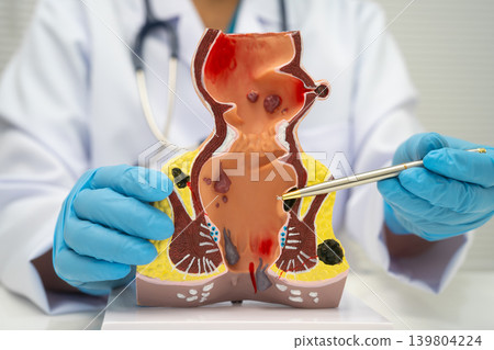 Asian doctor with rectum and hemorrhoid human model, inflamed vascular structure. Asian doctor with rectum and hemorrhoid human model, inflamed vascular structure. 139804224
