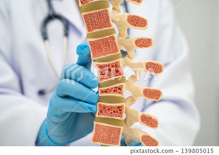 Doctor holding osteoporosis in back bone model for treatment medical in orthopedic department. Doctor holding osteoporosis in back bone model for treatment medical in orthopedic department. 139805015