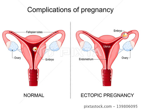 Ectopic pregnancy. Complications of pregnancy Ectopic pregnancy. Complications of pregnancy 139806095