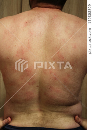 allergic rash 139808809