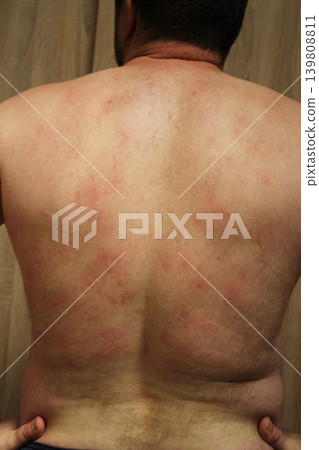 allergic rash allergic rash 139808811