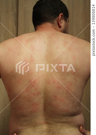 allergic rash allergic rash 139808814