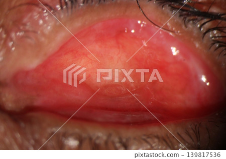 Contracted Socket Syndrome. Contracted socket syndrome characterized by a shallow and shrunken anophthalmic eye socket. Contracted Socket Syndrome. Contracted socket syndrome characterized by a shallow and shrunken anophthalmic eye socket. 139817536