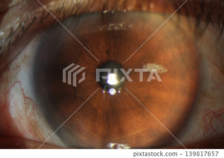 Slit lamp photograph demonstrating localized iris atrophy in the nasal quadrant. Slit lamp photograph demonstrating localized iris atrophy in the nasal quadrant. 139817657