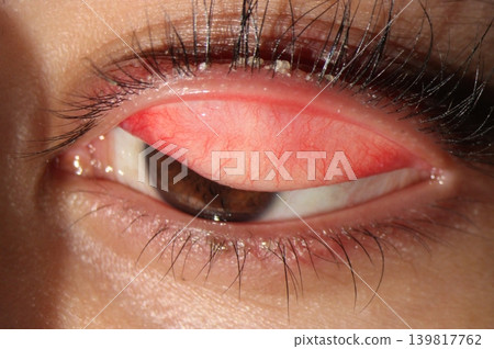 Anterior blepharitis. Slit lamp photograph demonstrating eyelash base crusting and mild tarsal conjunctival inflammation Anterior blepharitis. Slit lamp photograph demonstrating eyelash base crusting and mild tarsal conjunctival inflammation 139817762