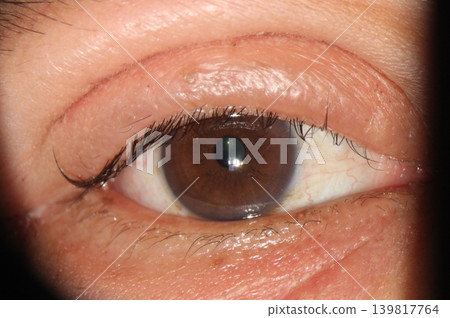 Close-up of an inflamed and swollen upper eyelid typical of blepharitis. Close-up of an inflamed and swollen upper eyelid typical of blepharitis. 139817764