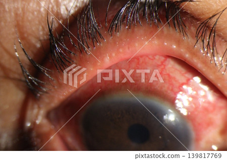 Eyelid margin showing multiple capped meibomian gland orifices with small whitish plugs consistent with meibomian gland dysfunction associated with blepharitis Eyelid margin showing multiple capped meibomian gland orifices with small whitish plugs consistent with meibomian gland dysfunction associated with blepharitis 139817769