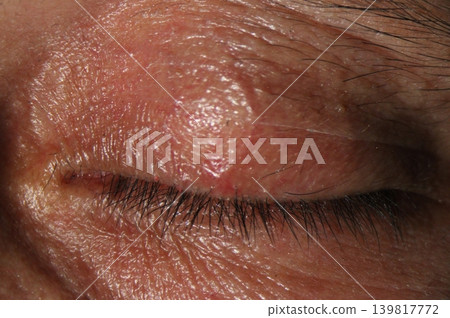 Inflamed upper eyelid showing mild edema and eyelash crusting typical of blepharitis. Inflamed upper eyelid showing mild edema and eyelash crusting typical of blepharitis. 139817772