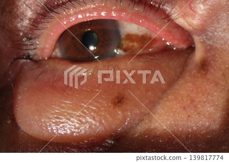 Mild eyelid margin inflammation with crusting and tearing along the eyelashes consistent with blepharitis Mild eyelid margin inflammation with crusting and tearing along the eyelashes consistent with blepharitis 139817774