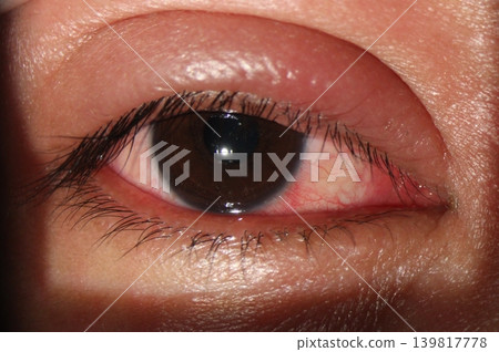 Swollen and erythematous upper eyelid associated with blepharitis and conjunctival redness. Swollen and erythematous upper eyelid associated with blepharitis and conjunctival redness. 139817778