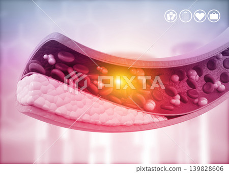 Atherosclerosis, Cholesterol plaque in artery Atherosclerosis, Cholesterol plaque in artery 139828606