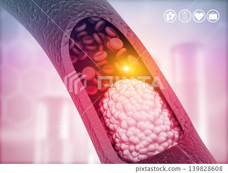 Atherosclerosis, Cholesterol plaque in artery Atherosclerosis, Cholesterol plaque in artery 139828608