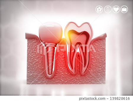 Tooth implant, Dental concept Tooth implant, Dental concept 139828616