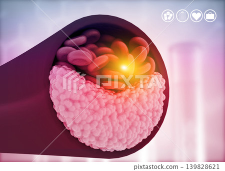 Atherosclerosis, Cholesterol plaque in artery Atherosclerosis, Cholesterol plaque in artery 139828621