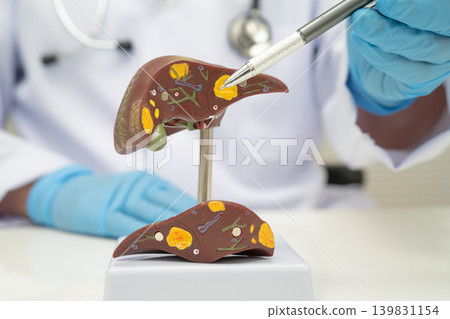Cirrhosis, Liver cancer, fatty liver, Asian doctor with liver human anatomy model in World Hepatitis Day at hospital. Cirrhosis, Liver cancer, fatty liver, Asian doctor with liver human anatomy model in World Hepatitis Day at hospital. 139831154