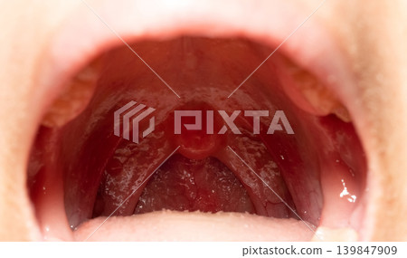 Sore throat with throat swollen. Closeup open mouth with posterior pharyngeal wall swelling and uvula and tonsil. Influenza follicles in the posterior pharyngeal wall. Upper respiratory tract. Sore throat with throat swollen. Closeup open mouth with posterior pharyngeal wall swelling and uvula and tonsil. Influenza follicles in the posterior pharyngeal wall. Upper respiratory tract. 139847909