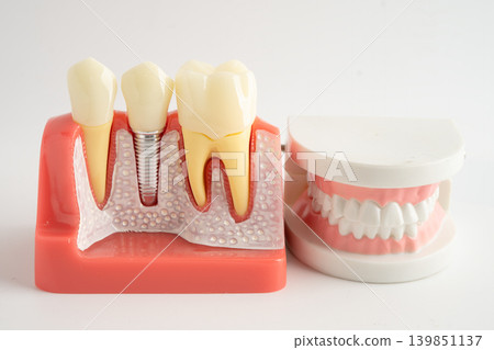 Dental implant, artificial tooth roots into jaw, root canal of dental treatment, gum disease, teeth model for dentist studying about dentistry. 139851137