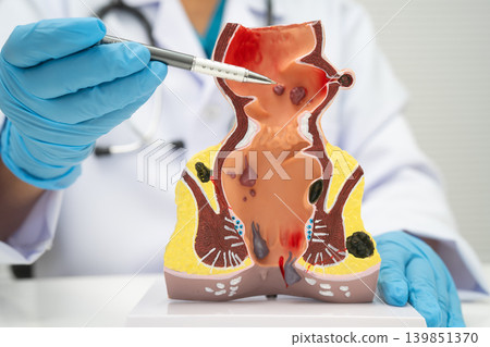 Asian doctor with rectum and hemorrhoid human model, inflamed vascular structure. Asian doctor with rectum and hemorrhoid human model, inflamed vascular structure. 139851370
