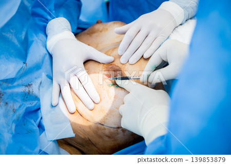 Surgery to remove the breast and replace it with an implant. Surgery to remove the breast and replace it with an implant. 139853879