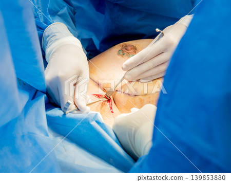 Surgery to remove the breast and replace it with an implant. Surgery to remove the breast and replace it with an implant. 139853880