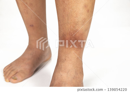 Senior man develop cellulitis in the lower leg. Senior man develop cellulitis in the lower leg. 139854220