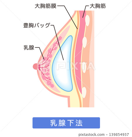矽膠假體隆乳:隆乳手術結構(腺體下植入法) 矽膠假體隆乳:隆乳手術結構(腺體下植入法) 139854937