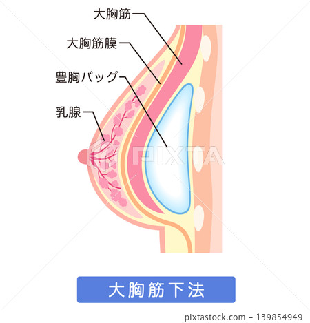 矽膠假體隆乳:隆乳手術結構,肌肉下植入法。 矽膠假體隆乳:隆乳手術結構,肌肉下植入法。 139854949