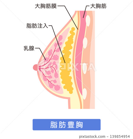 自體脂肪隆乳;隆乳手術結構;自體脂肪隆乳。 自體脂肪隆乳;隆乳手術結構;自體脂肪隆乳。 139854954