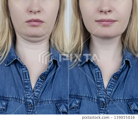 Double chin reduction before and after liposuction. Female neck lift, smas lifting, mentoplasty and genioplasty surgery result. Cosmetic plastic operation transformation. Double chin reduction before and after liposuction. Female neck lift, smas lifting, mentoplasty and genioplasty surgery result. Cosmetic plastic operation transformation. 139855816