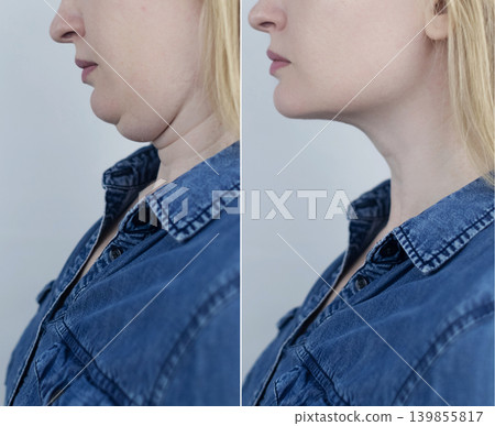 Double chin reduction before and after liposuction. Female neck lift, smas lifting, mentoplasty and genioplasty surgery result. Cosmetic plastic operation transformation. Double chin reduction before and after liposuction. Female neck lift, smas lifting, mentoplasty and genioplasty surgery result. Cosmetic plastic operation transformation. 139855817