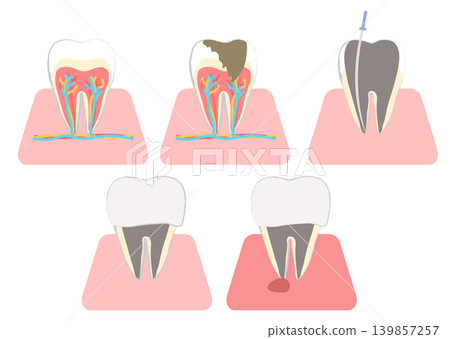 Illustration of the internal structure of a molar: Root canal treatment, abscess Illustration of the internal structure of a molar: Root canal treatment, abscess 139857257