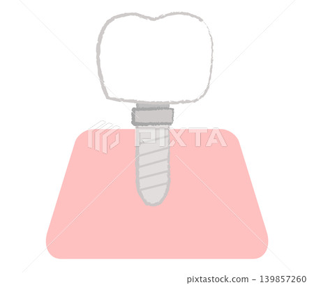 Illustration of dental implants Illustration of dental implants 139857260
