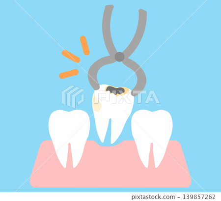 An illustration of extracting a tooth that has a cavity. An illustration of extracting a tooth that has a cavity. 139857262