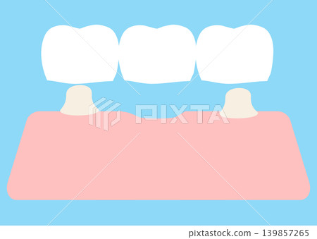 Illustration of a dental bridge Illustration of a dental bridge 139857265