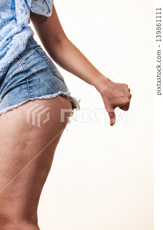 Woman legs with cellulite skin 139861111