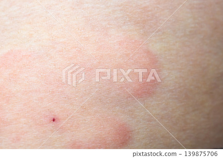 Skin allergy rash dermatitis texture close up background Skin allergy rash dermatitis texture close up background 139875706