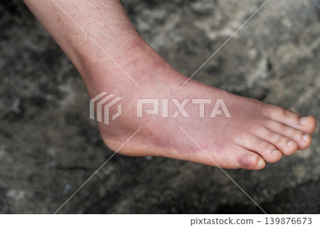 Swollen Foot After Cast Removal of Metatarsal Fracture Swollen Foot After Cast Removal of Metatarsal Fracture 139876673