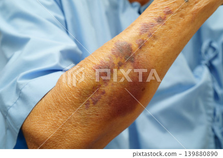 Ecchymosis, elderly bleeding on her arm after taking aspirin. 139880890
