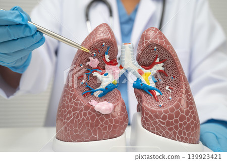 Pneumonia, lung cancer, Asian doctor with human lung model. 139923421