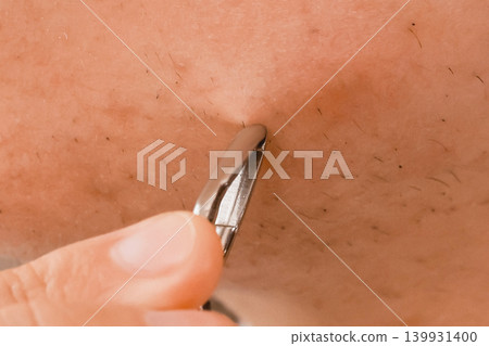 Close-up of plucking unwanted hair from skin on the chin. A daily home beauty care routine for face epilation and removal of hormonal mustache or facial hair. Close-up of plucking unwanted hair from skin on the chin. A daily home beauty care routine for face epilation and removal of hormonal mustache or facial hair. 139931400