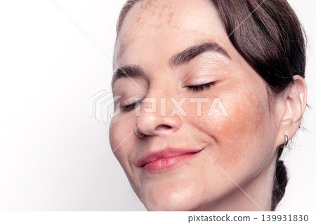 Pretty woman face with pigmentation, melasma, freckles, age spots skin problem. Smile girl Pretty woman face with pigmentation, melasma, freckles, age spots skin problem. Smile girl 139931830