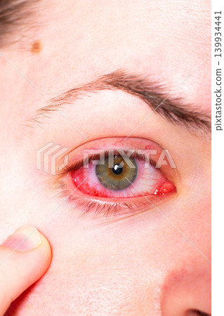 Female patient with painful red eye symptom. Seeking professional ophthalmologist care. Importance of timely eye exams. Drops therapy for infection recovery Female patient with painful red eye symptom. Seeking professional ophthalmologist care. Importance of timely eye exams. Drops therapy for infection recovery 139934441