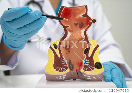 Asian doctor with rectum and hemorrhoid human model, inflamed vascular structure. 139947913