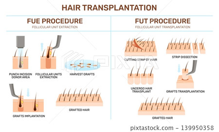 Hair transplantation infographic. Follicular unit extraction, medical educational poster design, trichologist, phases, steps and growth result, qualitative vector cartoon isolated concept Hair transplantation infographic. Follicular unit extraction, medical educational poster design, trichologist, phases, steps and growth result, qualitative vector cartoon isolated concept 139950358