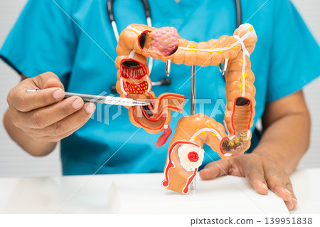 Colorectal cancer, doctor holding intestine colon human anatomy model. Colorectal cancer, doctor holding intestine colon human anatomy model. 139951838