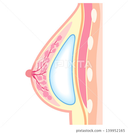 矽膠假體隆乳:隆乳手術結構(腺體下植入法) 矽膠假體隆乳:隆乳手術結構(腺體下植入法) 139952165